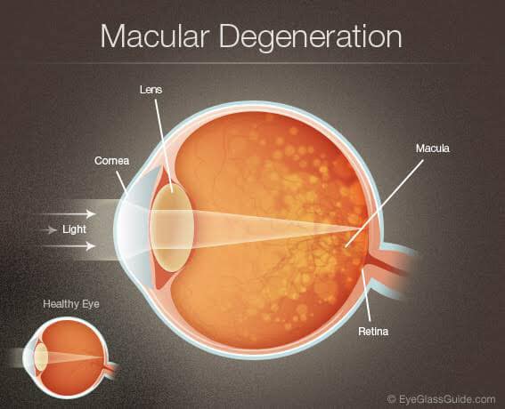 What Is Age-Related Macular Degeneration?